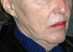 Revision Face Lift - Patient 1 - Obl Right - Before Revision Face Lift - Patient 1 - Obl Right - Before
